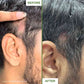 Derma Roller