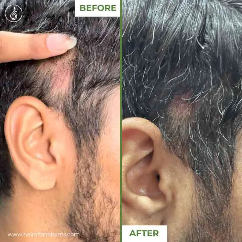 Derma Roller